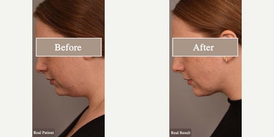 Case 9059 - Woman treated with Chin Liposuction
