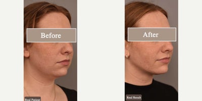 Case 9060 - Woman treated with Chin Liposuction