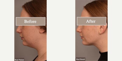 Case 9061 - Woman treated with Chin Liposuction