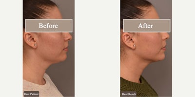 Case 9062 - Woman treated with Chin Liposuction