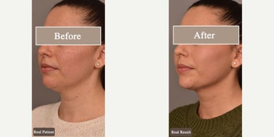 Case 9063 - Woman treated with Chin Liposuction