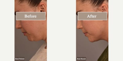Case 9064 - Woman treated with Chin Liposuction