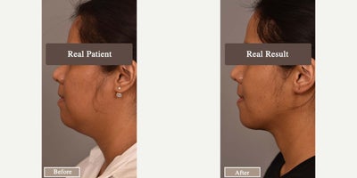 Case 9065 - Woman treated with Chin Liposuction