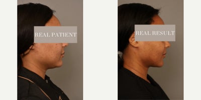 Case 9066 - Woman treated with Chin Liposuction