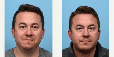 Case 9067 - 35-44 year old man treated with Chin Liposuction