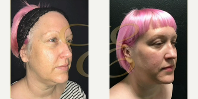 Case 9068 - Woman treated with Chin Liposuction