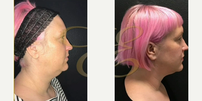 Case 9069 - Woman treated with Chin Liposuction