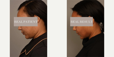 Case 9072 - Woman treated with Chin Liposuction