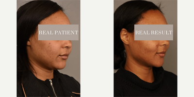 Case 9073 - Woman treated with Chin Liposuction