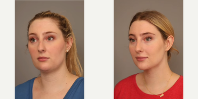 Case 9074 - Woman treated with Chin Liposuction