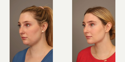 Case 9075 - Woman treated with Chin Liposuction
