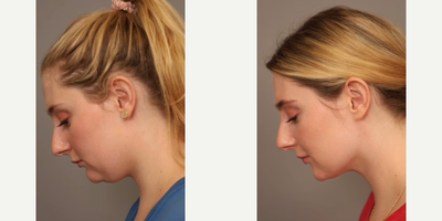 Case 9076 - Woman treated with Chin Liposuction