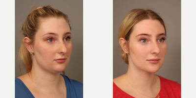 Case 9077 - Woman treated with Chin Liposuction