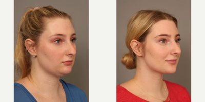 Case 9078 - Woman treated with Chin Liposuction