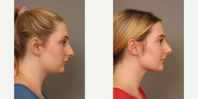 Case 9079 - Woman treated with Chin Liposuction