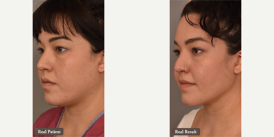 Case 9081 - Woman treated with Chin Liposuction
