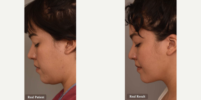 Case 9082 - Woman treated with Chin Liposuction