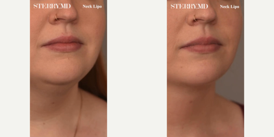 Case 9083 - Woman treated with Chin Liposuction