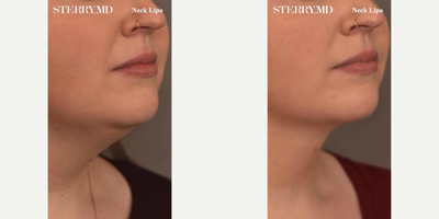 Case 9084 - Woman treated with Chin Liposuction