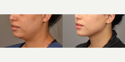 Case 9085 - Woman treated with Chin Liposuction
