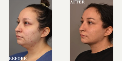 Case 9086 - Woman treated with Chin Liposuction