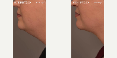 Case 9087 - Woman treated with Chin Liposuction