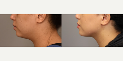 Case 9088 - Woman treated with Chin Liposuction