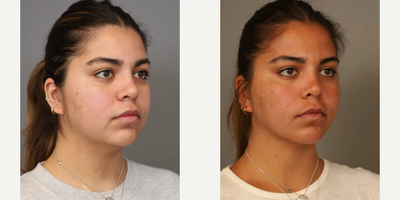 Case 9089 - Woman treated with Chin Liposuction