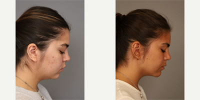 Case 9090 - Woman treated with Chin Liposuction
