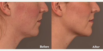 Case 9091 - Woman treated with Chin Liposuction