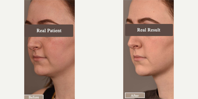 Case 9093 - Woman treated with Chin Liposuction