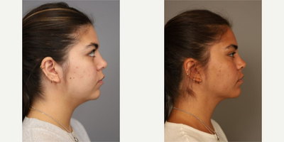 Case 9094 - Woman treated with Chin Liposuction