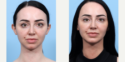 Case 9095 - 25-34 year old woman treated with Chin Implant, Chin Liposuction