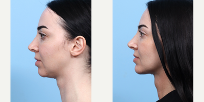 Case 9096 - 25-34 year old woman treated with Chin Implant, Chin Liposuction