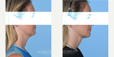 Case 9098 - Woman treated with Chin Liposuction