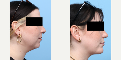 Case 9101 - 25-34 year old woman treated with Chin Liposuction, Chin Implant