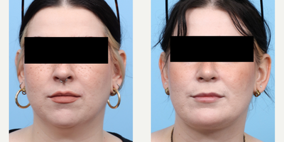 Case 9102 - 25-34 year old woman treated with Chin Liposuction, Chin Implant