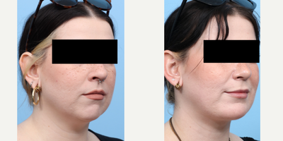 Case 9103 - 25-34 year old woman treated with Chin Liposuction, Chin Implant