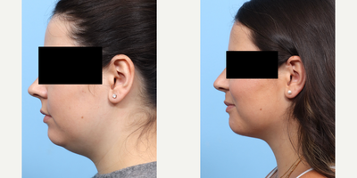 Case 9104 - 25-34 year old woman treated with Chin Liposuction