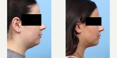 Case 9105 - 25-34 year old woman treated with Chin Liposuction