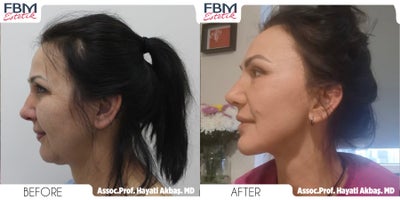 Case 9106 - 45-54 year old woman treated with Neck Lift, Chin Liposuction, Eyelid Surgery, Mini Facelift