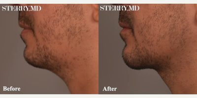 Case 9107 - Man treated with Chin Liposuction