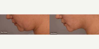 Case 9108 - Woman treated with Chin Liposuction