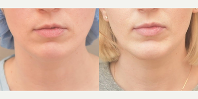 Case: 9109 - before and after photo of 25-34 year old woman treated with Chin Implant by Keshav Magge, MD