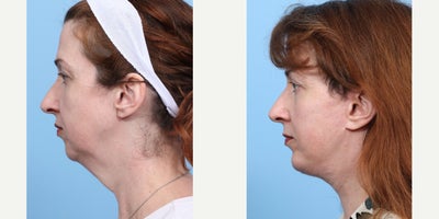 Case: 9110 - before and after photo of 45-54 year old woman treated with Chin Implant, Deep Plane Facelift by Jeffrey B. Wise, MD, FACS