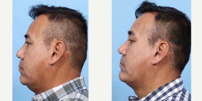 Case: 9111 - before and after photo of 55-64 year old man treated with Chin Implant, Facial Fat Transfer by Jeffrey B. Wise, MD, FACS
