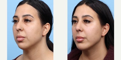 Case: 9112 - before and after photo of 25-34 year old woman treated with Chin Implant, Rhinoplasty by Jeffrey B. Wise, MD, FACS