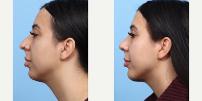 Case: 9113 - before and after photo of 25-34 year old woman treated with Chin Implant, Rhinoplasty by Jeffrey B. Wise, MD, FACS