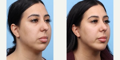 Case: 9114 - before and after photo of 25-34 year old woman treated with Chin Implant, Rhinoplasty by Jeffrey B. Wise, MD, FACS