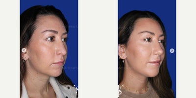 Case: 9115 - before and after photo of 35-44 year old woman treated with Chin Implant, Revision Rhinoplasty by Matthew Tamplen, MD